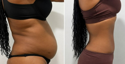 Before and after result 4 from the Celebrity Non-Surgical Tummy Tuck at Elle Amour Wellness