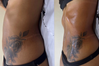 Before and after result 5 from the Celebrity Non-Surgical Tummy Tuck at Elle Amour Wellness