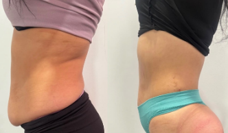Before and after result 6 from the Celebrity Non-Surgical Tummy Tuck at Elle Amour Wellness