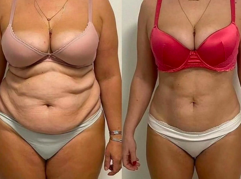 Before and after results from the Celebrity Non-Surgical Tummy Tuck at Elle Amour Wellness