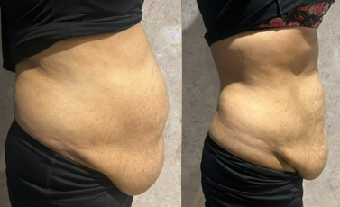 Before and after result 1 from the Celebrity Non-Surgical Tummy Tuck at Elle Amour Wellness
