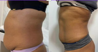 Before and after result 2 from the Celebrity Non-Surgical Tummy Tuck at Elle Amour Wellness