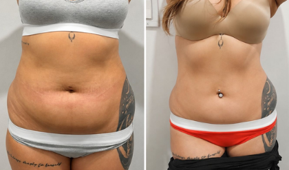 Before and after result 3 from the Celebrity Non-Surgical Tummy Tuck at Elle Amour Wellness